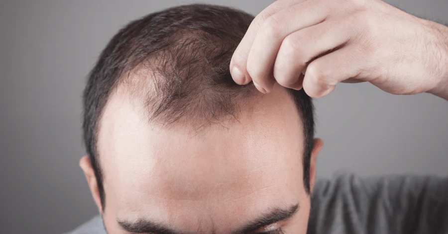 Genetic hair loss treatment
