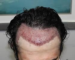 Hair transplant