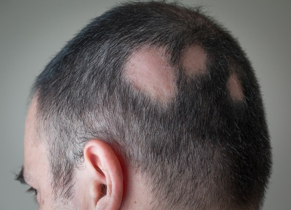 Alopecia treatment